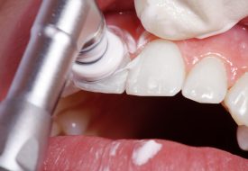 Kosmetische Zahnreinigung mit Polier Paste, Schritt 13